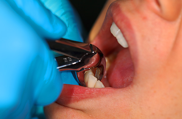 Dėželius pašalinti paprastai yra lengva, tačiau jei procedūros metu dantis lūžta, šaknį ištraukti gali būti nelengva.