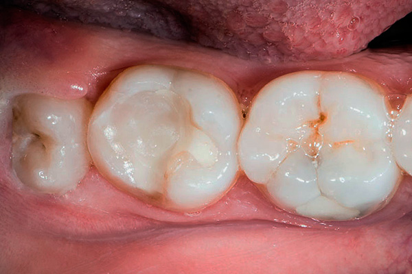 Auf der linken Seite befindet sich ein halbverstärkter Weisheitszahn (der teilweise unter dem Zahnfleisch verborgen ist).
