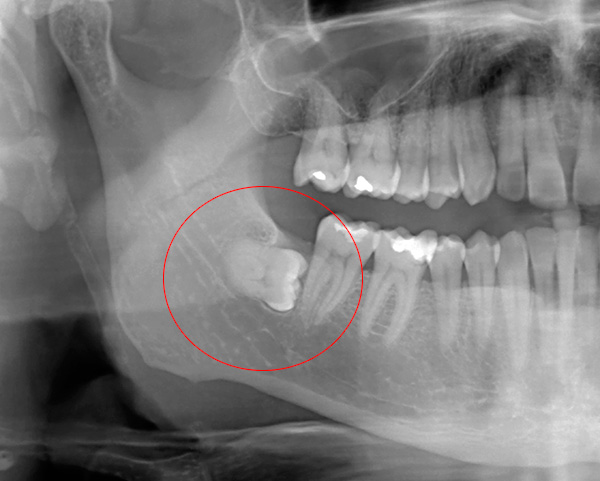 Dent de saviesa conservada: els preus per eliminar aquestes dents solen ser els més elevats.