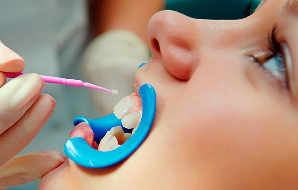 Mit der Fluorierung des Zahnschmelzes wird es säurebeständiger.