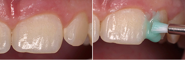 The photo shows the initial stage of caries treatment using Icon technology.