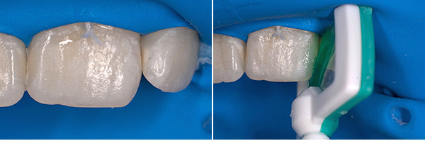 Die Poren des demineralisierten Zahnschmelzes müssen sorgfältig mit einer polymerisierbaren Zusammensetzung gefüllt werden ...