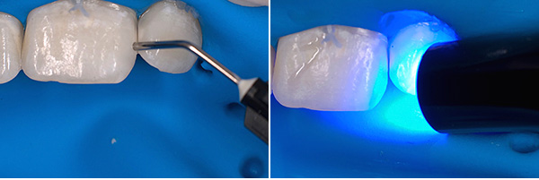 На последния етап от процедурата полимерът се втвърдява от светлината на UV лампа.