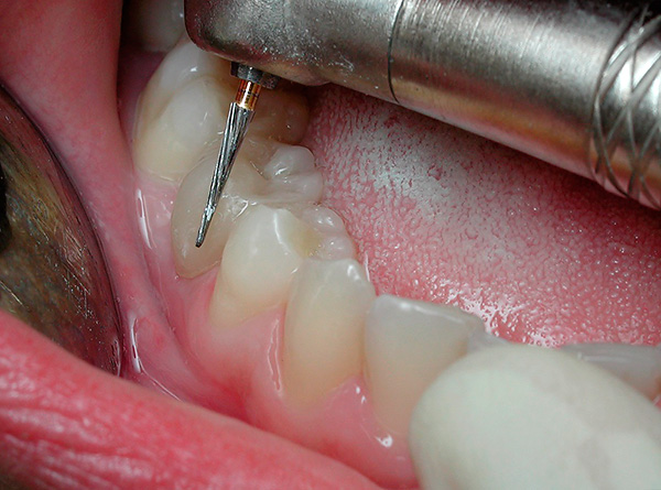 Enamel-affected areas of enamel can be sanded with a drill and sealed with light-curing filling material.