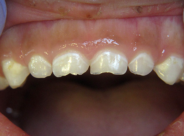 Decayed caries on baby teeth