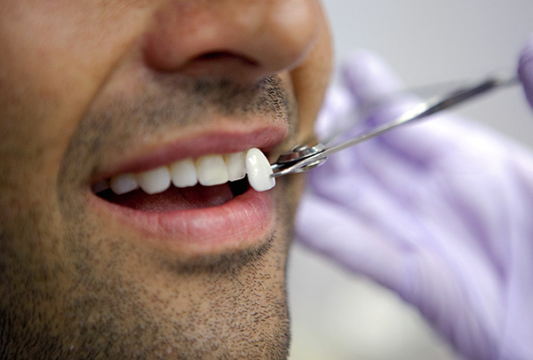 วีเนียร์เป็นเยื่อบุบาง ๆ (เช่นเซรามิก) ซึ่งสามารถปรับปรุงลักษณะที่ปรากฏของฟันที่มีปัญหาได้อย่างมีนัยสำคัญ