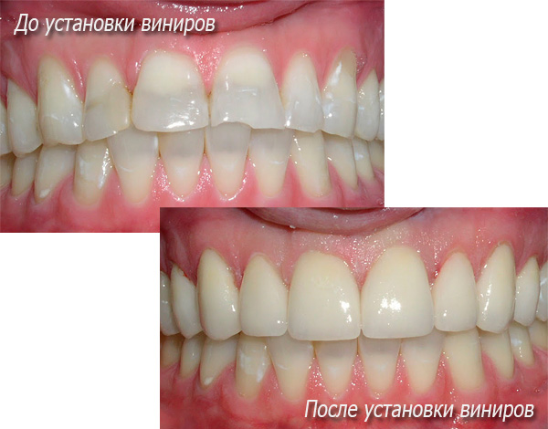 Bildet viser tilstanden til pasientens tenner før og etter montering av finérene ...