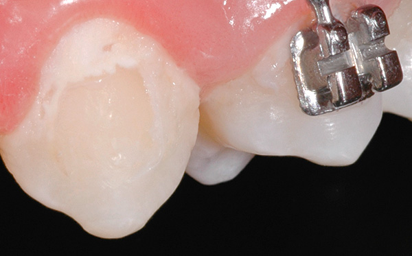 With prolonged wearing of braces in the area of ​​locks, carious white areas are often formed.