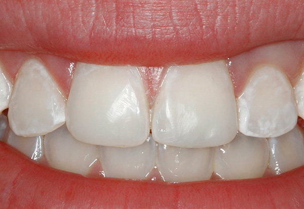 Obvykle je zubní kaz ve stádiu bílého (křídového) bodu nejzřetelněji viditelný na čelní skupině zubů.
