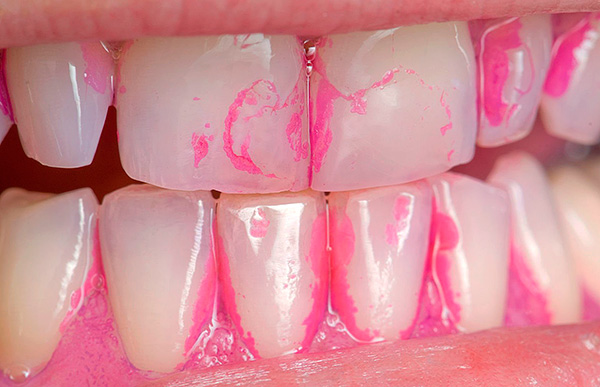 Zur Identifizierung von Bereichen mit demineralisiertem Zahnschmelz wird ein spezieller Farbstoff (Kariesindikator) verwendet.
