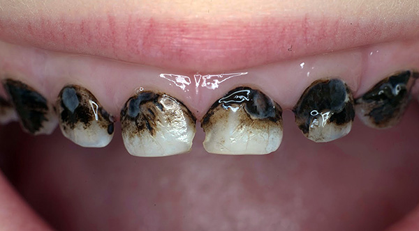 La foto muestra los dientes de leche plateados de un niño.