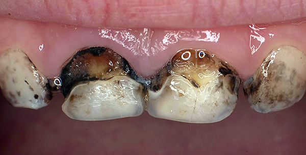 Souvent, l'argenture des dents n'affecte pas de manière significative le développement ultérieur du processus carieux.