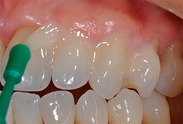 Tandbehandling med speciella preparat kan stoppa utvecklingen av initial karies och i vissa fall till och med helt eliminera vita fläckar på emaljen.