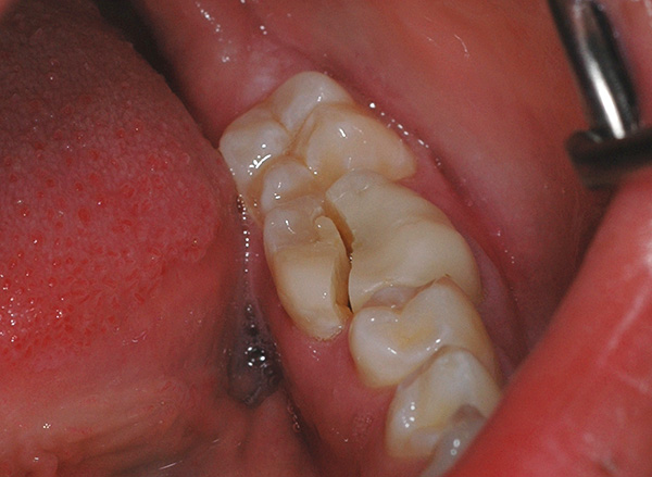 Још један пример веома неуспешног прелома зуба, када је највероватније потребно раздвојити га.