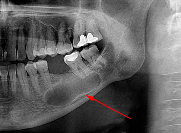 Fotografia ukazuje príklad obrovskej cysty, ktorá už zachytáva korene dvoch zubov naraz.