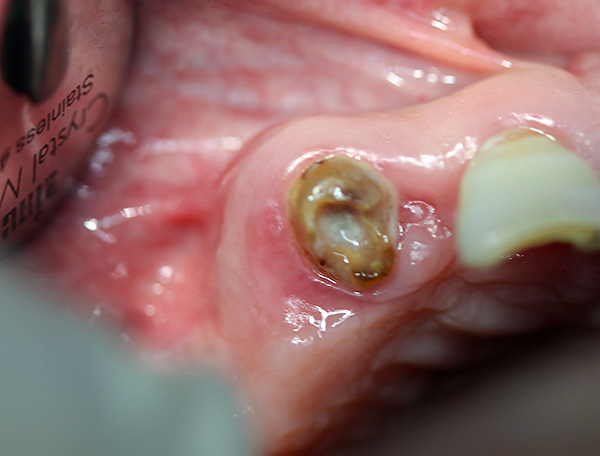 It may seem that grabbing such a root of a damaged tooth with forceps will be quite problematic, although in practice this is often not difficult.