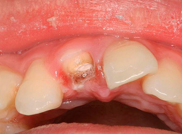 De wortel van zo'n zwaar beschadigde tand moet worden verwijderd.