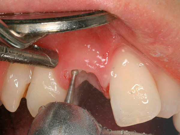 De wortel van de tand wordt door een boor in delen gesneden ...