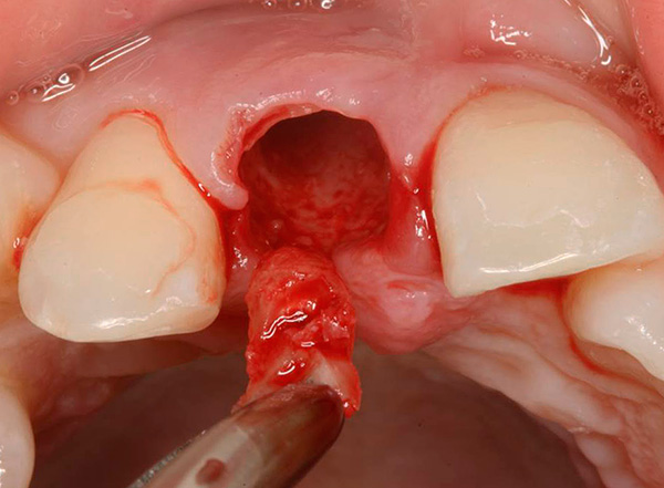 Dadurch wird die gesamte Zahnwurzel aus dem Loch entfernt.