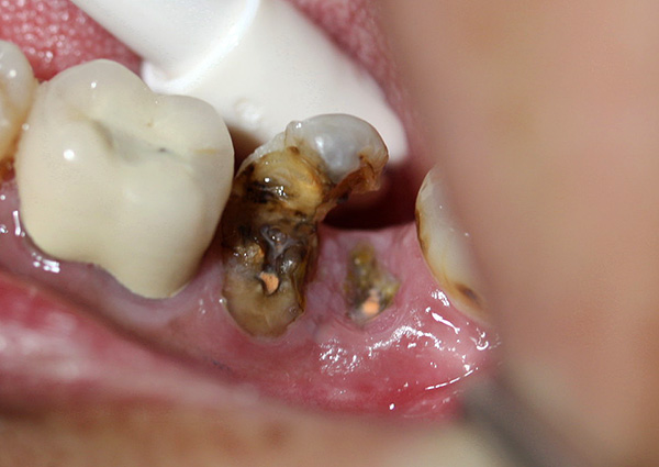 En pacients envellits, l’eliminació de les arrels de les dents en descomposició, per regla general, no presenta grans dificultats.
