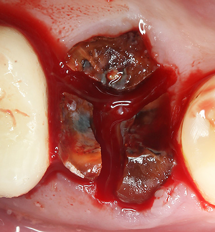 De wortels van de tand worden gescheiden door een boor om de procedure voor het verwijderen uit het gat te vereenvoudigen.