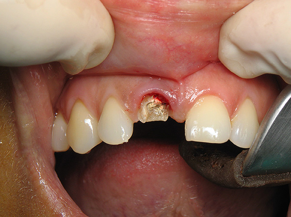 An example of a front incisor injury in which the root cannot be saved - it needs to be removed.
