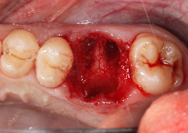 Μερικές φορές, όταν απομακρύνεται ένα δόντι στην τρύπα, μπορεί να παραμείνει μια σπασμένη κορυφή της ρίζας ή μόνο τα μικρά θραύσματα ...