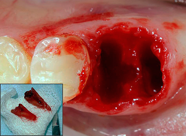 Hvis legen ikke fjernet tannen helt, er det bedre å søke gjentatt hjelp slik at hullet til slutt er fri for uønskede inneslutninger.