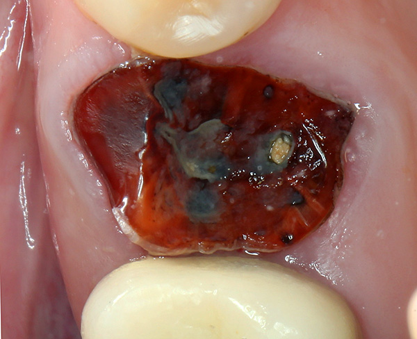 Through and through rotten tooth roots must be removed without fail, and the sooner this is done, the better.
