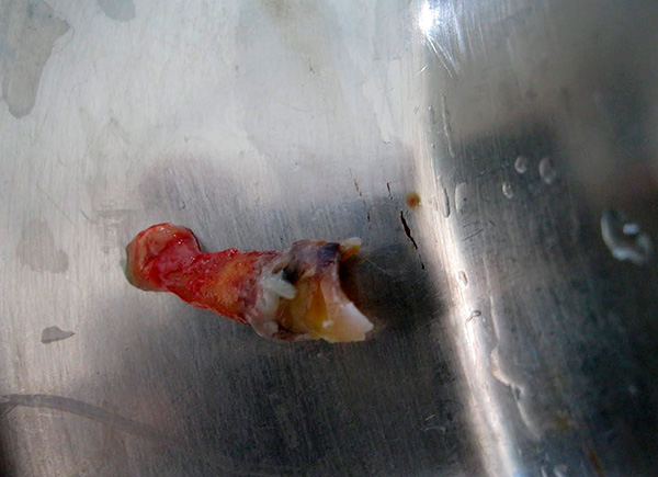 A removed tooth with a cyst on the root