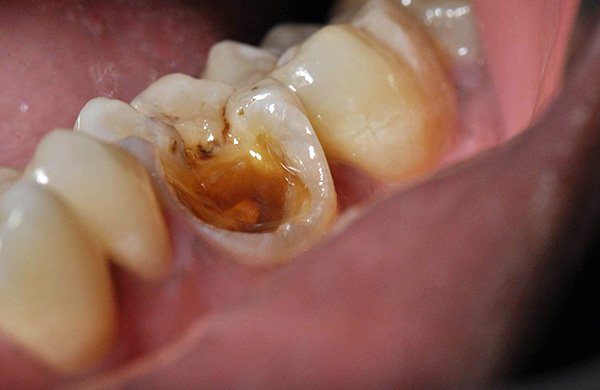 Hvis et stykke, til og med et stort, bryter vekk fra tannen, betyr ikke det at du må skille deg fra tannen.