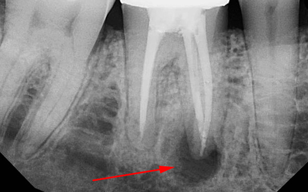 Rentgen ukazuje cystu zubu v oblasti vrcholu kořene.