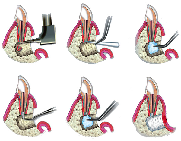 Le immagini mostrano schematicamente la procedura per la resezione dell'apice della radice del dente.