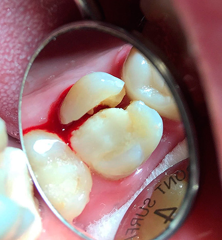 Bij een dergelijke tandbreuk is het meestal onderhevig aan verwijdering.