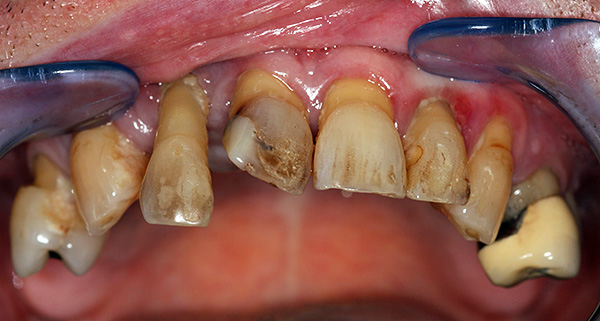Un altre exemple de l’estat de les dents a la mandíbula superior abans del tractament ...
