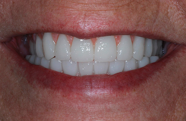 Yleisesti ottaen voidaan sanoa, että kaikkia neljää tekniikkaa käyttävä hammasproteesointi on melko kallista nautintoa.