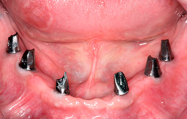 Protezējot, izmantojot tehnoloģiju All-on-6, tiek izmantoti 6 implanti.