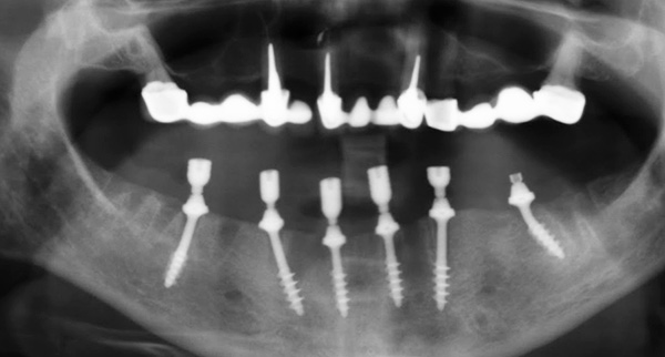 Basal implants are fixed in a dense layer of bone, so their primary stability is very high.