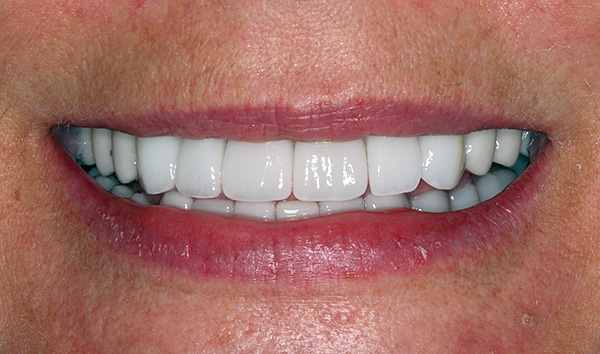 All-on-4 diş restorasyon teknolojisinin estetiği ve yiyecekleri çiğneme yeteneğini hızlı bir şekilde geri yüklemenize izin vermesine rağmen, her klinik bu tekniği bilen bir implantolog bulamaz.
