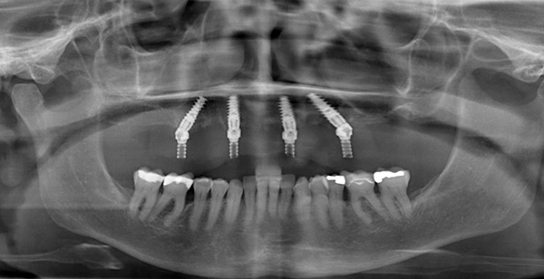 Nuotraukoje parodyta, kad du implantai pritvirtinti vertikaliai, o du - kampu.