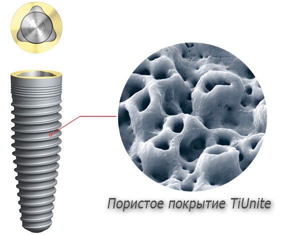Titāna implantu virsmai ir īpašs porains pārklājums, kas atvieglo implanta saplūšanas procesu ar kaulaudiem.