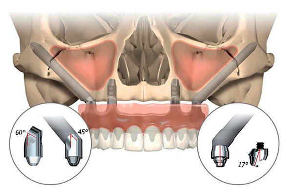 When implementing the All-on-4 technology, thanks to the inclined implant placement, it is possible, in particular, to avoid damage to the nasal sinuses and jaw nerves.
