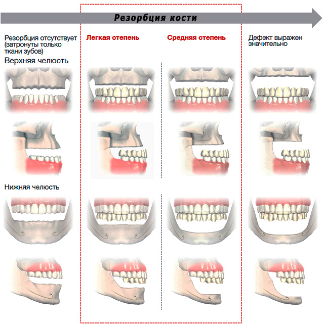 The picture shows how the jaw of a person looks with varying degrees of bone resorption.