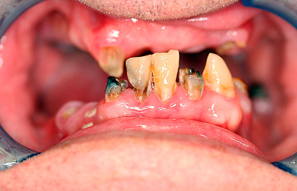 De foto toont de toestand van de tanden van de patiënt vóór protheses.