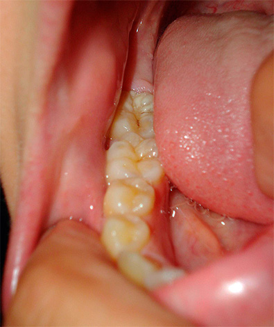 При успешен резултат от терапевтичните мерки кистата се разтваря и зъбът може да продължи още много години.