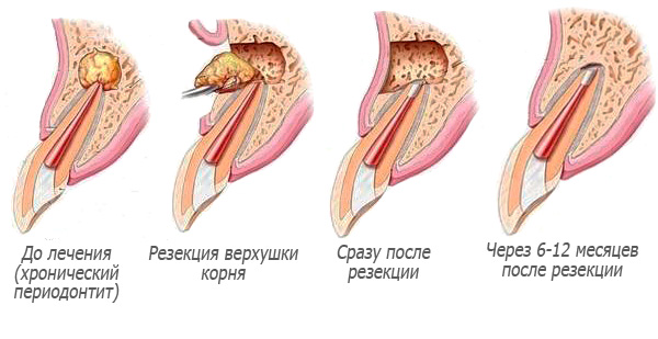 Схемата на резекция на върха на зъбния корен