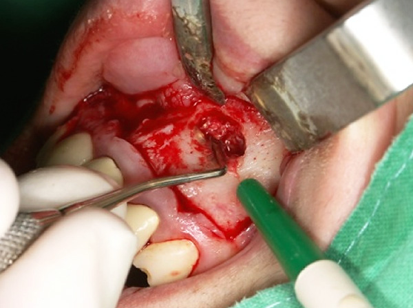 After removal of the cyst, the cavity that it occupied thoroughly scrapes out ...
