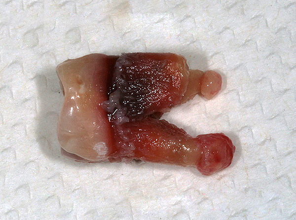 Ein entfernter Zahn, an dessen Wurzeln Zysten deutlich sichtbar sind.
