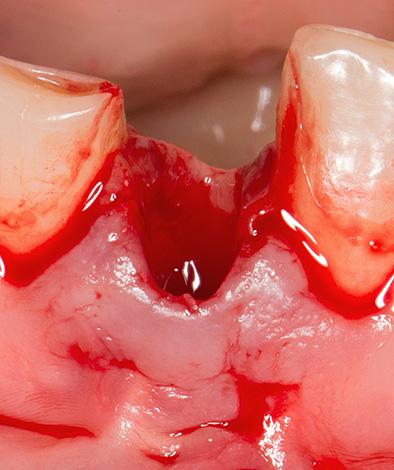 En el orificio lleno de sangre, es posible que el médico no considere los fragmentos izquierdos del diente y los restos del quiste.