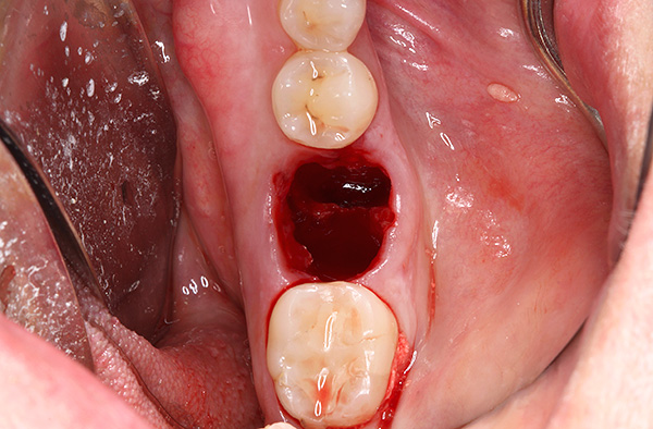 في بعض الأحيان في مثل هذا الثقب يوجد حتى جزء من جذر الأسنان مع الكيس بأكمله.
